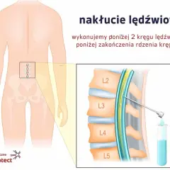 Ilustracja pokazuje punkcję kręgosłupa w odcinku lędźwiowym, poniżej zakończenia rdzenia kręgowego, z igłą wprowadzana między kręgi L3 i L4.