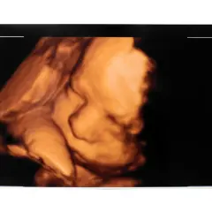 Ecografia 3D di un feto. Il profilo del bambino è ben visibile, con la bocca e il naso definiti. Dopo la morfologica si può stare tranquilli.