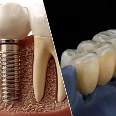 Implant stomatologiczny i most protetyczny na zatrzaskach.