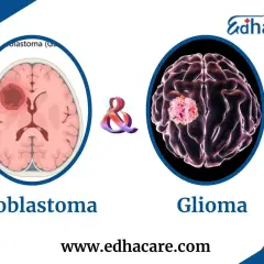Ilustracje mózgu pokazujące guzy. Po lewej glioblastoma, po prawej glioma. Wczesne wykrycie glejaków i ich objawów jest kluczowe.