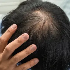 Vue rapprochée du sommet de la tête d'un homme montrant une calvitie naissante. La main d'un homme touche son cuir chevelu, peut-être en réfléchissant à la cause de sa calvitie.