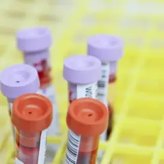 Krebsvorsorge Blutuntersuchung: Wie der PanTum Detect Test Leben retten kann