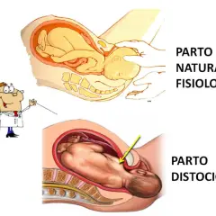 Illustrazione di un parto naturale fisiologico e di un parto distocico, dove il bambino è in posizione anomala.