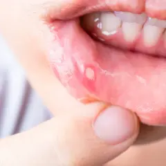 L'immagine mostra una vescicola dolorosa sulla mucosa labiale, tipica della stomatite erpetica. Quanto dura? Solitamente una settimana.