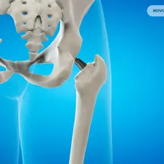 Endoproteza stawu biodrowego: implant zastępujący uszkodzoną kość. Widok anatomiczny.
