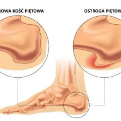 Ból pięty? Leki na zapalenie powięzi podeszwy od apteki po blokadę