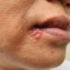 Widoczne pęcherzyki i zaczerwienienie wskazują na opryszczkę na policzku, która pojawiła się blisko ust.