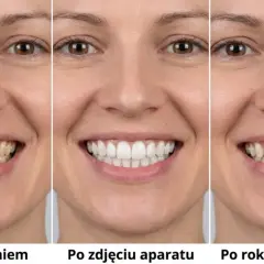 Uśmiech kobiety przed leczeniem, po zdjęciu aparatu i po roku bez retencji. Widać, że drut retencyjny pomógł utrzymać efekt.