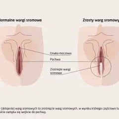 Ilustracja pokazuje, jak wygląda cipa: normalne wargi sromowe i zrośnięte wargi sromowe, z zaznaczoną cewką moczową i pochwą.