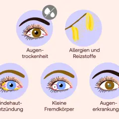 Illustrationen zeigen Ursachen für brennende Augen: Trockenheit, Allergene, Bindehautentzündung, Fremdkörper und allgemeine Augenerkrankungen.
