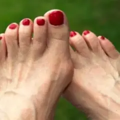 Pies con uñas rojas, mostrando un juanete. Buscando remedios caseros para el dolor de juanetes.