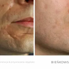 Przed i po lipofilling twarzy: widoczna poprawa blizn i przywrócenie objętości skóry.