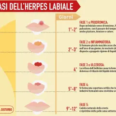 Le fasi dell'herpes labiale: dalla fase prodromica (1-2 giorni) con pizzicore, alla formazione di vescicole (2-3 giorni), ulcere (4° giorno), crosticine (5-8 giorni) fino alla guarigione (9-12 giorni). Le cause del herpes labiale frequente sono legate ...