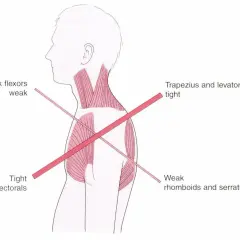 Anatomia mięśni: napięty mięsień czworoboczny, osłabione zginacze karku, napięte mięśnie piersiowe, osłabione mięśnie równoległoboczne i zębaty przedni.