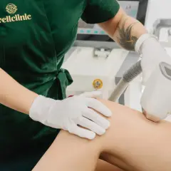 Depilacja laserowa co ile zabiegi – poznaj optymalne odstępy