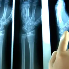 Radiografie del polso mostrano una mano con possibile distorsione al polso. Un dito indica un'area di interesse.
