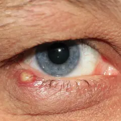 Ein entzündeter Gerstenkorn am Augenlid, der Juckreiz verursacht. Das Auge ist rot und geschwollen.