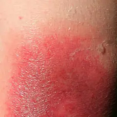 Symptome Borreliose beim Menschen: Warnzeichen, die Sie kennen sollten
