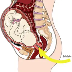 Der Schleimpfropf, ein gallertartiger Pfropfen, verschließt den Muttermund während der Schwangerschaft. Sein Aussehen ist hier schematisch dargestellt.