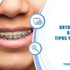 Sonrisa con ortodoncia. Descubre cuánto cuesta la ortodoncia y los tipos de brackets disponibles en Torres & González.