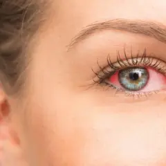 Occhio con congiuntiva arrossata e irritata, sintomo di secchezza oculare.