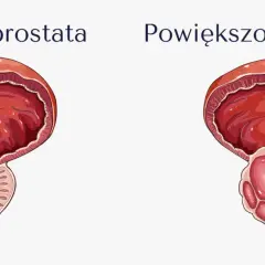 Porównanie zdrowej i powiększonej prostaty. Nowoczesne leki na prostatę pomagają przywrócić prawidłowy przepływ.