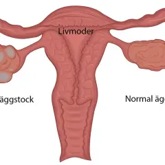 Illustration av livmoder med en normal äggstock och en polycystisk äggstock, en vanlig pcos symptom.