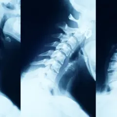 Rentgen kręgosłupa szyjnego ukazujący zmiany zwyrodnieniowe. Widoczne są osteofity i zwężenia przestrzeni międzykręgowych, świadczące o zaawansowanym zwyrodnieniu kręgosłupa.
