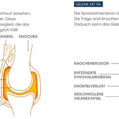 Die entscheidende Rolle der Diagnostik bei rheumatischer Arthritis