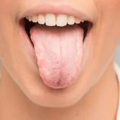 Boca abierta mostrando lengua rosada y blanca, con posible acidez en la boca y lengua.
