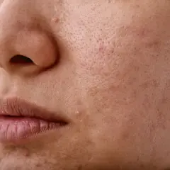 Skóra z widocznymi porami i śladami po niedoskonałościach, sugerującymi nadmierne wydzielanie sebum.