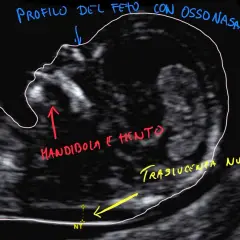 Profilo fetale con osso nasale, mandibola e mento visibili. Misurazione traslucenza nucale (NT) per bi test.