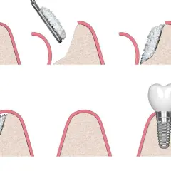 Illustrazione delle fasi di un innesto osseo dentale: preparazione, aggiunta di materiale osseo e inserimento dell'impianto.