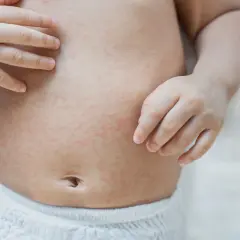 Dziecko ma na brzuchu czerwoną wysypkę. Dwie małe rączki delikatnie dotykają jego brzuszka.