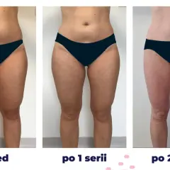 Przed i po kriolipolizie: widoczne efekty wyszczuplenia ud i talii po 1 i 2 seriach zabiegu.