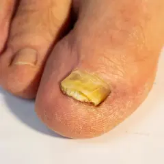 Primo piano di un alluce con unghia gialla e spessa, segno di un'infezione fungina.