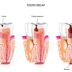 Ropa w dziąśle: Co robić? Ulga w bólu i pilna wizyta u dentysty
