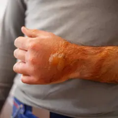 Verbrannte Haut am Unterarm und Handrücken, die braun und geschwollen ist, mit einer Blase.