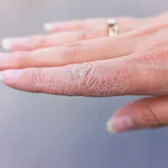 En hand med torr, spruckna fingertoppar. En ring syns på ett finger.