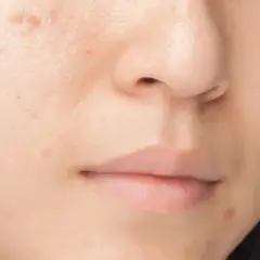 Närbild på en persons ansikte med synliga pigmentfläckar och ojämnheter i melanin hud.