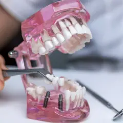 Model szczęki z implantami, gdzie pęsetą umieszczany jest nowy ząb. Pokazane jest wstawienie zęba.