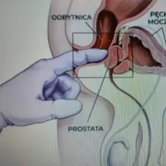 Anatomical illustration showing a gloved finger performing a prostate massage through the rectum.