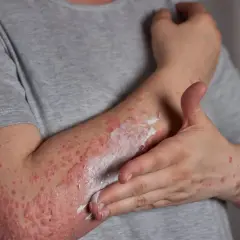 Person cremt Arm mit Neurodermitis ein. Die Haut ist gerötet und schuppig. Die richtige Kleidung bei Neurodermitis ist wichtig.