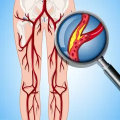 Wichtige Diagnosetechniken der peripheren arteriellen Verschlusskrankheit