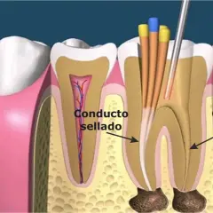 Ilustración de un diente mostrando un conducto radicular sellado y otro sin sellar, con instrumentos dentales. Esto explica qué es una reendodoncia.