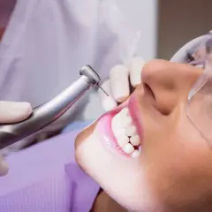 Visita dentistica per rimuovere il tartaro dai denti. La paziente indossa occhiali protettivi mentre il dentista usa uno strumento rotante.