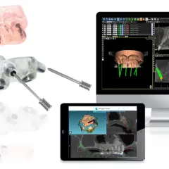 Componenti per chirurgia guidata dentale: guide, impianti e software di pianificazione 3D.