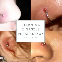 Infekcja kolczyka w pępku: Jak rozpoznać objawy i skutecznie leczyć?