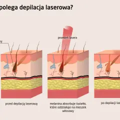 Depilacja laserowa: Jak działa? Gładka skóra bez tajemnic!