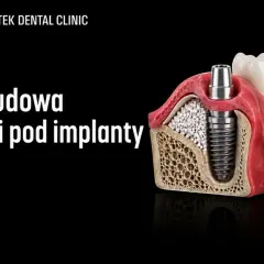 Model szczęki z implantem i materiałem do augmentacji kości. Kwiatek Dental Clinic.